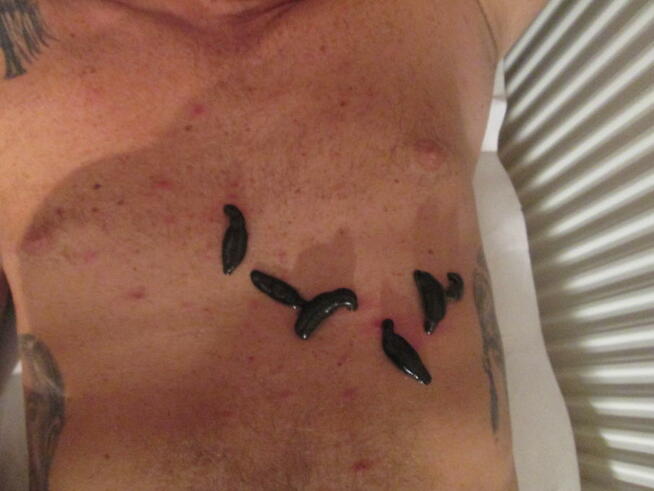 Hirudoterapia Leczenie pijawkami Jarocin Pleszew Ostrów Wlkp