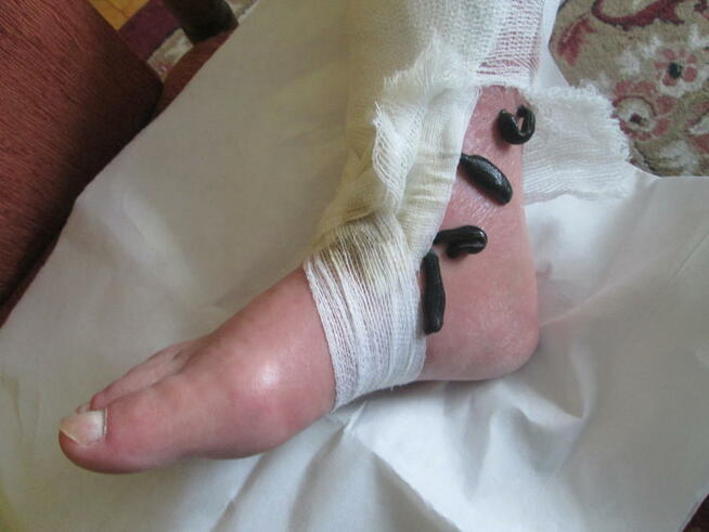 Hirudoterapia Leczenie pijawkami Jarocin Pleszew Ostrów Wlkp