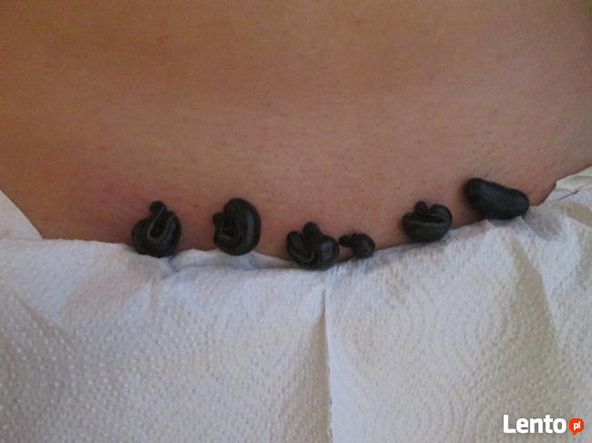 Hirudoterapia Leczenie pijawkami Jarocin Pleszew Ostrów Wlkp