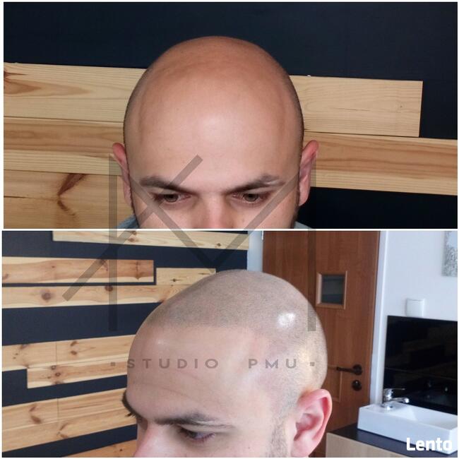 Mikropigmentacja skóry głowy Scalp Micropigmentation