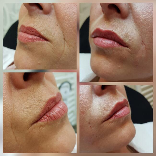 Medycyna estetyczna Luboń wypełnianie ust kwasem hialuronowy