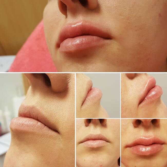 Medycyna estetyczna Luboń wypełnianie ust kwasem hialuronowy