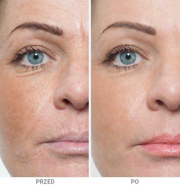 Medycyna estetyczna Luboń wypełnianie ust kwasem hialuronowy