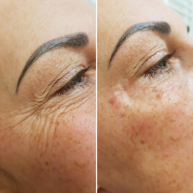 Medycyna estetyczna Luboń wypełnianie ust kwasem hialuronowy