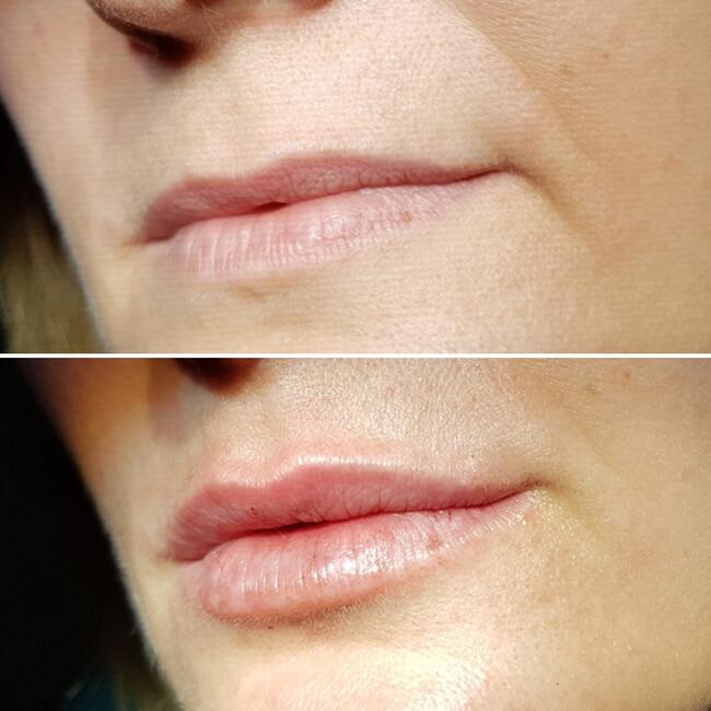 Medycyna estetyczna Luboń wypełnianie ust kwasem hialuronowy