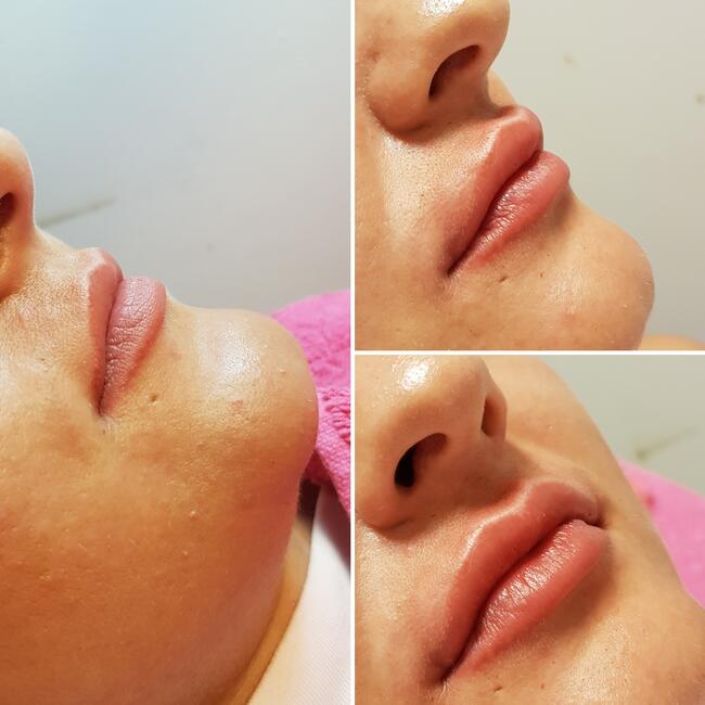 Medycyna estetyczna Luboń wypełnianie ust kwasem hialuronowy