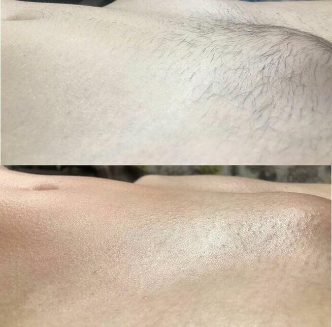 Depilacja wszystkich części ciała