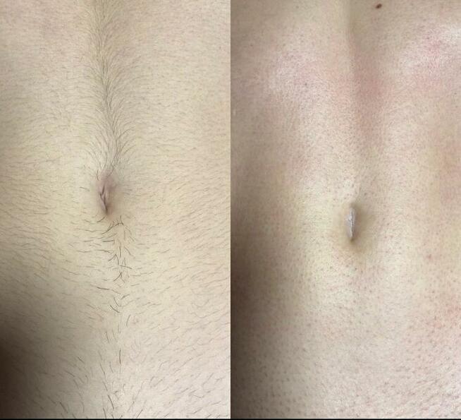 Depilacja wszystkich części ciała