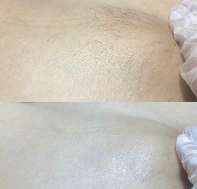 Depilacja wszystkich części ciała