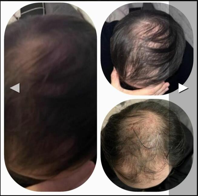 Lifting bez skalpela