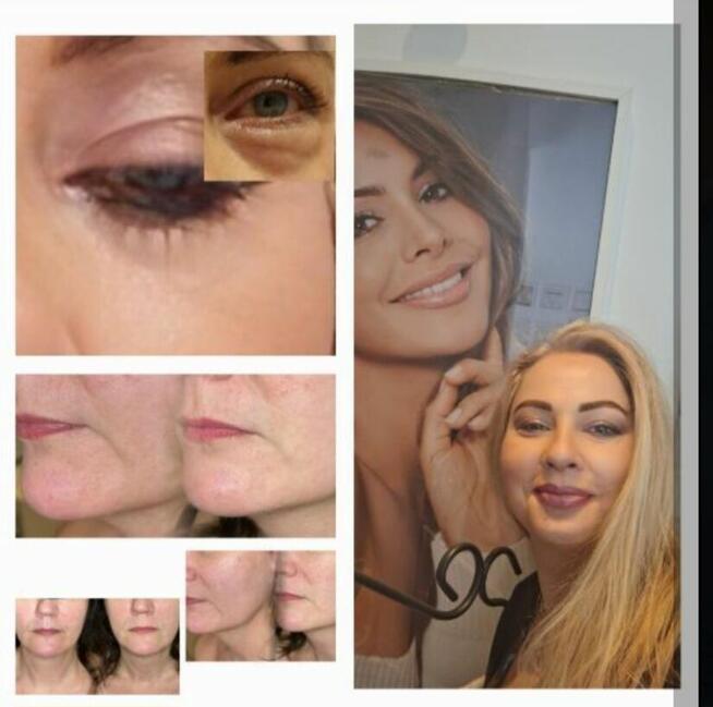 Lifting bez skalpela