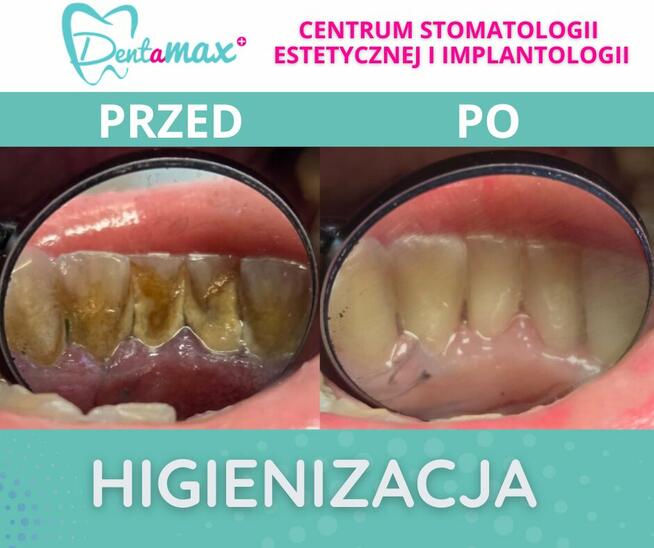 Higienizacja Zębów - Dentamax Kraków