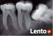 Pantomografia .RTG zebów