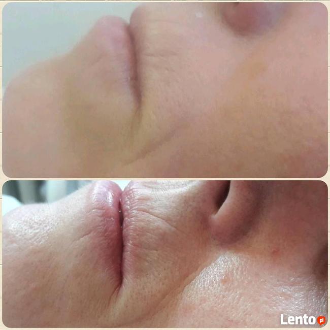 HIFU SYGMALIFT PROMOCJA 399zł Gorzow Wielkopolski