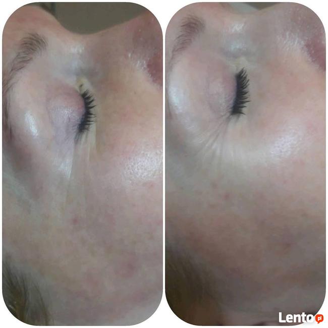 HIFU SYGMALIFT PROMOCJA 399zł Gorzow Wielkopolski