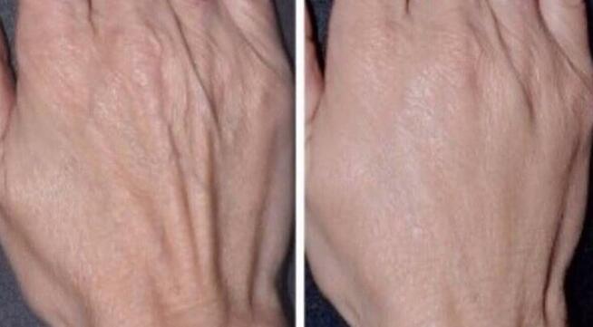 Botoks, kwas hialuronowy, nici PDO Katowice