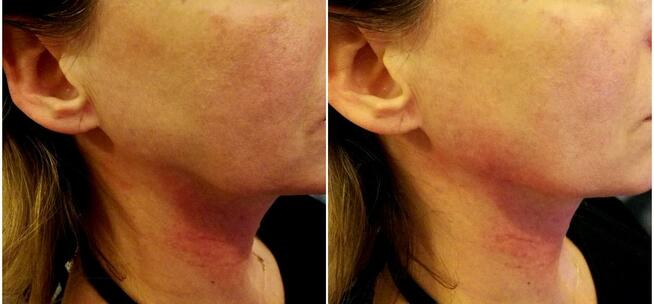 Botoks, kwas hialuronowy, nici PDO Katowice