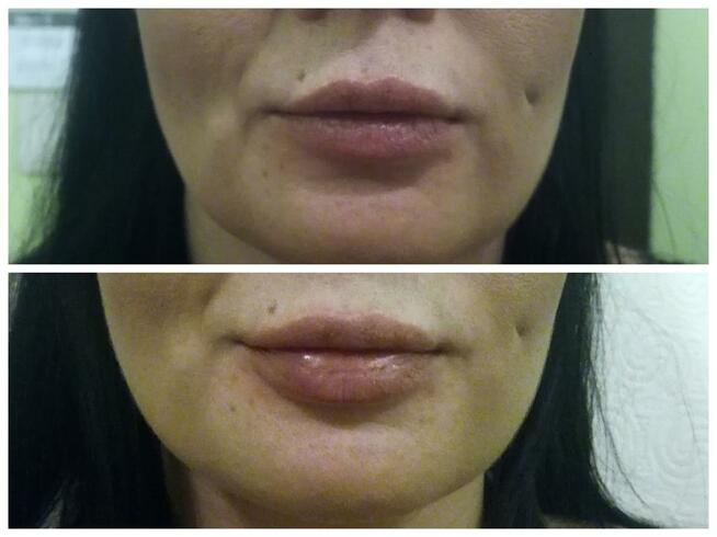 Botoks, kwas hialuronowy, nici PDO Katowice