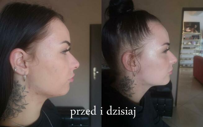 Botoks, kwas hialuronowy, nici PDO Katowice