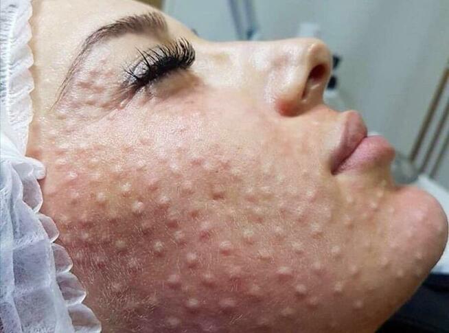 Botoks, kwas hialuronowy, nici PDO Katowice