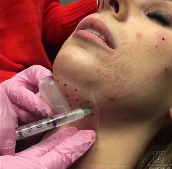 Botoks, kwas hialuronowy, nici PDO Katowice