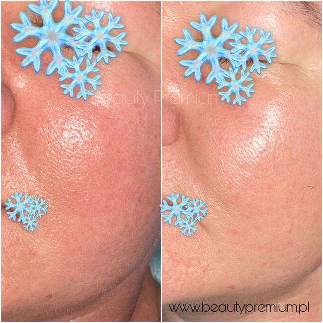 Bezbolesne zamykanie naczynek + konsultacja kosmetologa