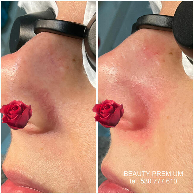 Egzosomy + radiofrekwencja mikroigłowa