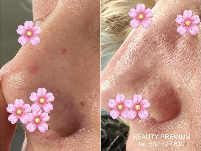 Egzosomy + radiofrekwencja mikroigłowa