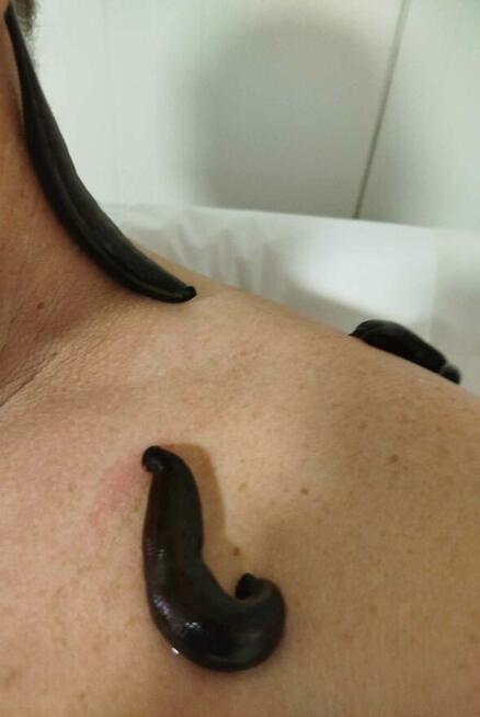 Pijawki lekarskie - Gabinet Hirudoterapii Lutomiersk