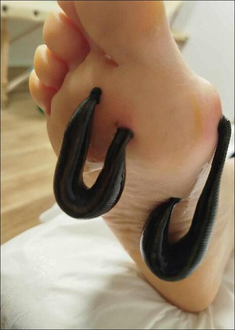 Pijawki lekarskie - Gabinet Hirudoterapii Lutomiersk