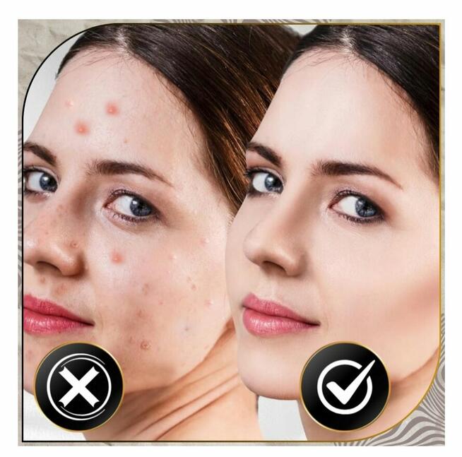 URZĄDZENIE DO TERAPII OZONOWEJ REDUKCJA ZMARSZCZEK I TRĄDZIK