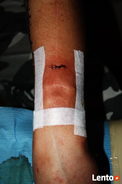 PIERCING SKARYFIKACJE IMPLANTY i inne - Warszawa