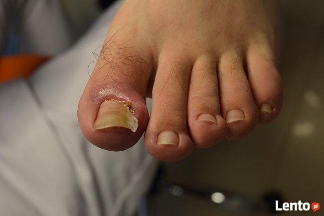 Chemioterapia podologia wrastające i wkręcające paznokcie