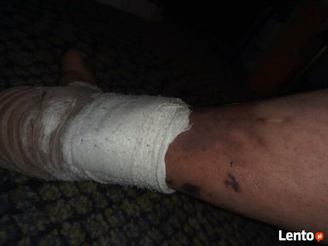 Michałowi grozi amputacja! Pomóż! Pilnie potrzebna pomoc