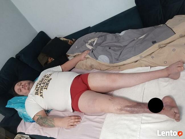 Michałowi grozi amputacja! Pomóż! Pilnie potrzebna pomoc