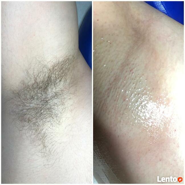depilacja pastą cukrową