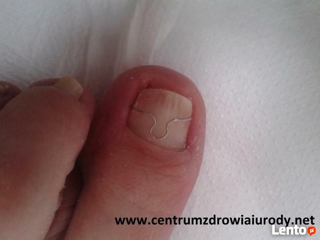 wrastające paznokcie, odciski, modzele, pękające pięty