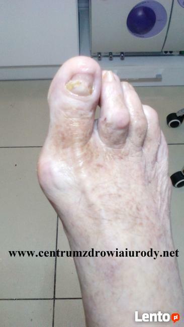 wrastające paznokcie, odciski, modzele, pękające pięty