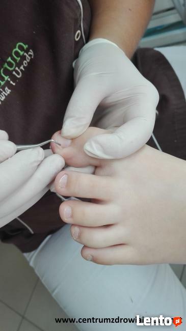 wrastające paznokcie, odciski, modzele, pękające pięty