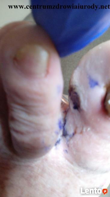 wrastające paznokcie, odciski, modzele, pękające pięty