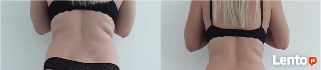 Endermologia LPG Alliance