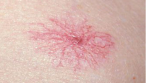 NACZYNKA/ WŁÓKNIAKI/ BRODAWKI/kaszaki/prosaki