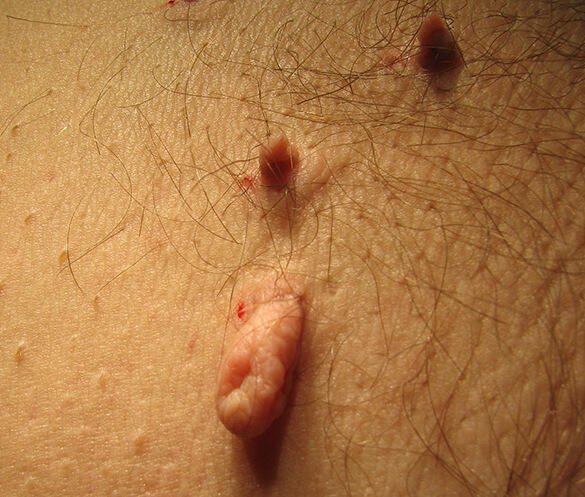 NACZYNKA/ WŁÓKNIAKI/ BRODAWKI/kaszaki/prosaki