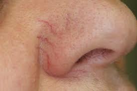 NACZYNKA/ WŁÓKNIAKI/ BRODAWKI/kaszaki/prosaki