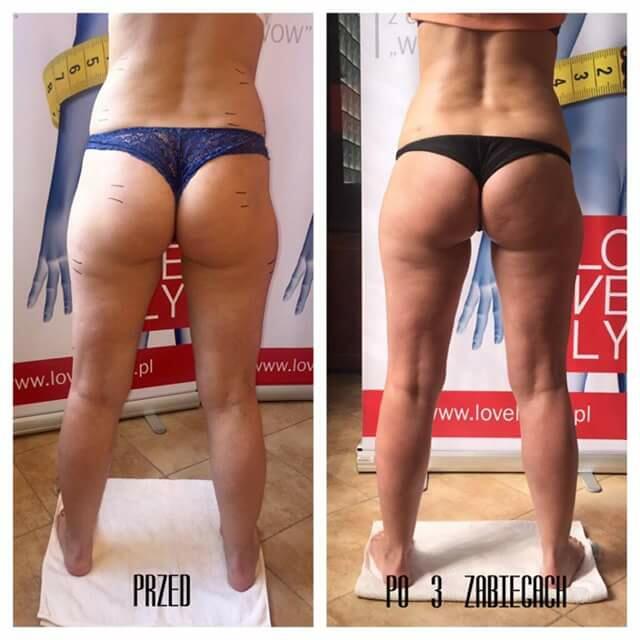 Szybki sposób na pozbycie się cellulitu
