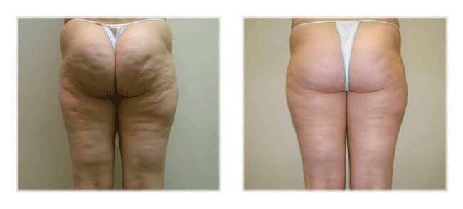 Szybki sposób na pozbycie się cellulitu