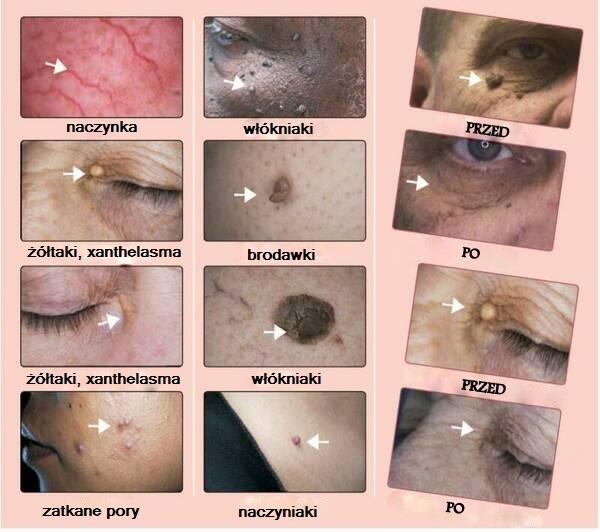 NACZYNKA/ WŁÓKNIAKI/ BRODAWKI/kaszaki/prosaki