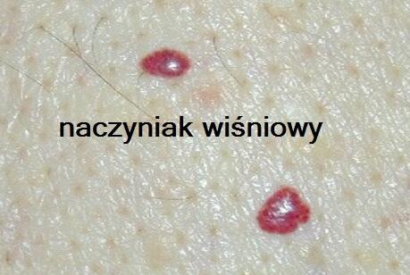 NACZYNKA/ WŁÓKNIAKI/ BRODAWKI/kaszaki/prosaki