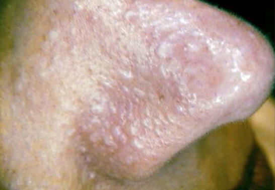 NACZYNKA/ WŁÓKNIAKI/ BRODAWKI/kaszaki/prosaki