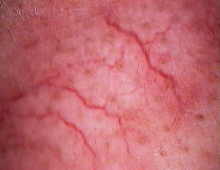 NACZYNKA/ WŁÓKNIAKI/ BRODAWKI/kaszaki/prosaki